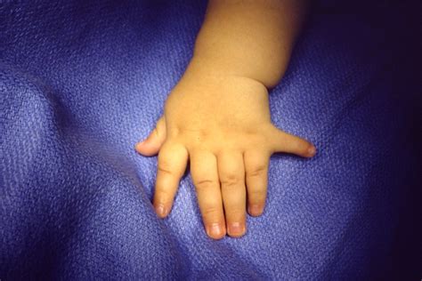 Polydactyly - observation | Hand Surgery Source