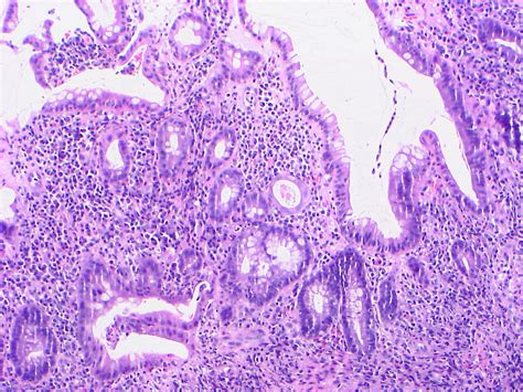 Pathology Outlines - Ulcerative colitis