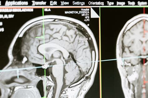 Agenesis Of Corpus Callosum : Overview, Causes, Symptoms, Treatment - illness.com