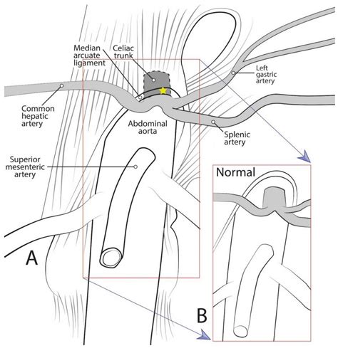 Median Arcuate Ligament Syndrome / Median Arcuate Ligament Syndrome - Vascular Case Studies ...