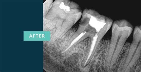 Root Canal Root Canal Molar Root Canals