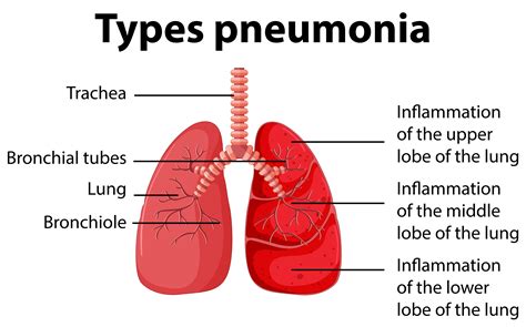 Diagram showing types pneumonia 413792 Vector Art at Vecteezy