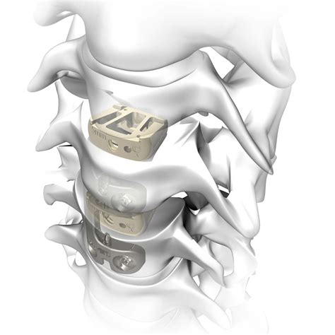 Cervical interbody fusion cage - Rebar - Atlas Spine - anterior / PEEK