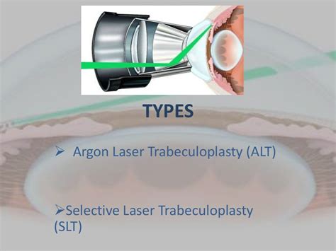 Laser trabeculoplasty