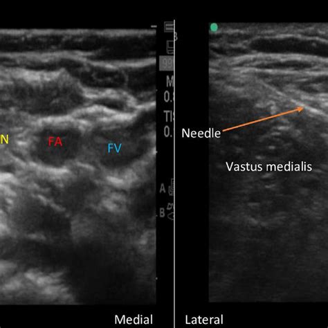 In-plane approach of femoral nerve block and Adductor canal block. FN,... | Download Scientific ...