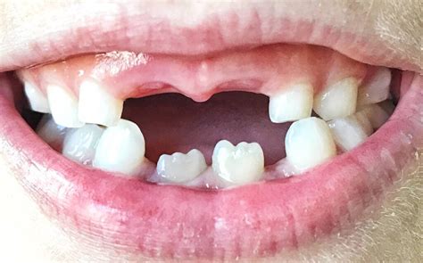 Hypodontia: Causes, Diagnosis, Treatment | Fillmore Dental