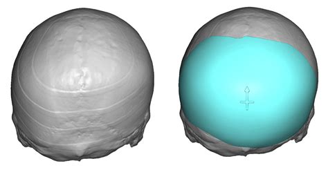 Custom Skull Implant design back view for Righth Occipital ...