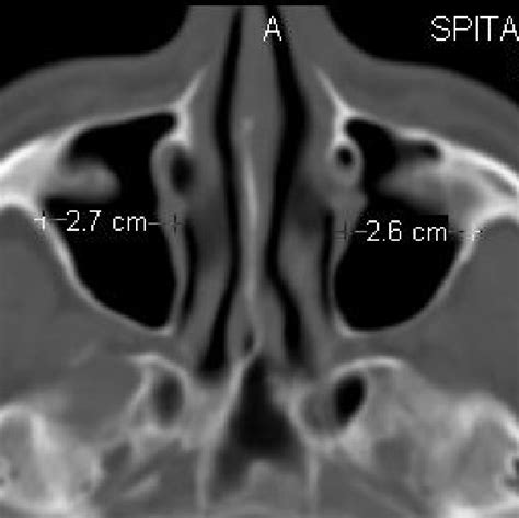 Both maxillary sinus presented a septum inside. | Download Scientific ...