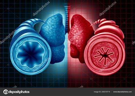 Asthma Health Diagnosis Diagram Healthy Unhealthy Bronchial Tube Constricted Breathing — Stock ...