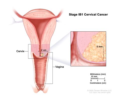 Cervical Cancer Treatment (PDQ®)–Health Professional Version - Siteman ...