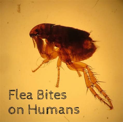 Flea Bites on Humans: Symptoms and Treatment - Dengarden