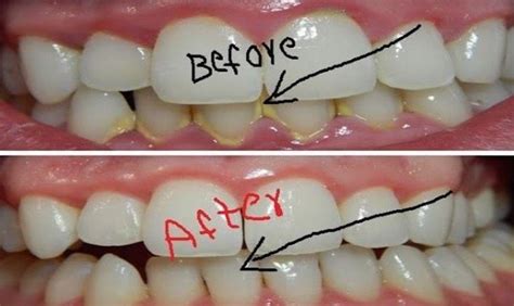 This Mouthwash Removes Plaque From Teeth In 2 Minutes | Emergency ...