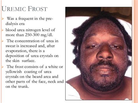 Uremic Frost In Ckd : Uremic frost information including symptoms ...