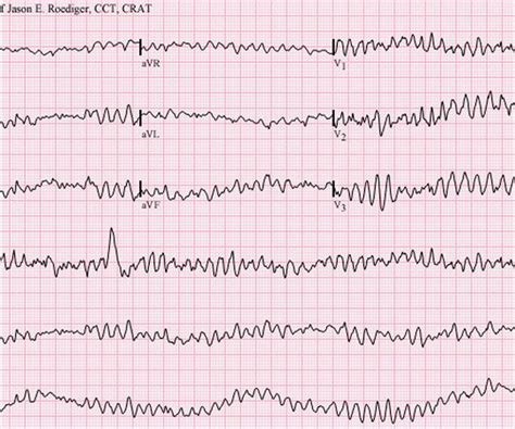 Médico cardiólogo en Avilés: causas de la fibrilación ventricular