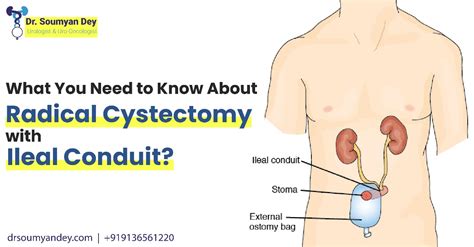 Understanding Radical Cystectomy with Ileal Conduit