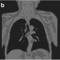 Soft-tissue attenuation correction (AC) of PET images based on MRI ...