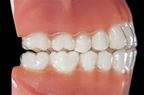 Invisalign Before And After Timeline | Before And After