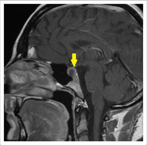 Magnetic resonance imaging (MRI) of a lesion in the sella turcica. This... | Download Scientific ...