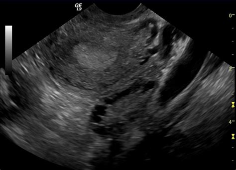 Polycystic Ovary Syndrome; Stein-Leventhal Syndrome