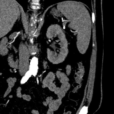 Bilateral delayed nephrogram from renal artery stenosis | Image ...