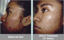 Vitalize Chemical Peel® Virginia Beach | Skin Care Treatment