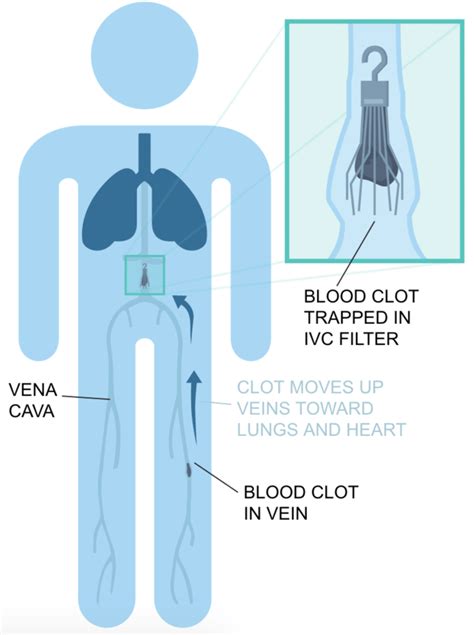 Inferior Vena Cava Diagram