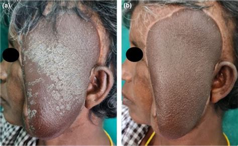 Dermatosis neglecta - Palaniappan - 2022 - Clinical and Experimental Dermatology - Wiley Online ...