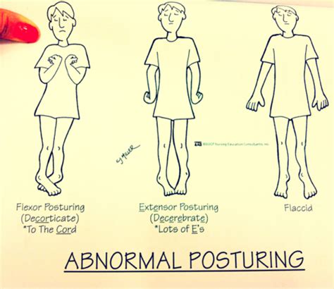 Another great way to remember Decorticate Posturing is that you turn inwards toward your CORE ...