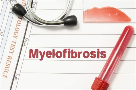 Unveiling the 10 Signs of Myelofibrosis - Facty Health