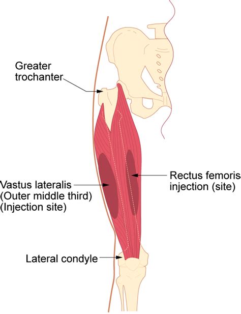 7.4 Intramuscular Injections – Clinical Procedures for Safer Patient Care