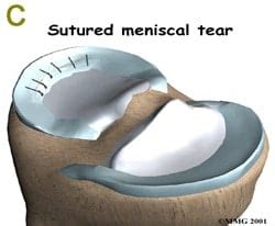 Bucket Handle Meniscus Tear – Howard J. Luks, MD