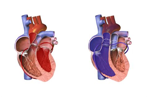 Dextro-Transposition of the Great Arteries (D-TGA) - Treatment - StoryMD