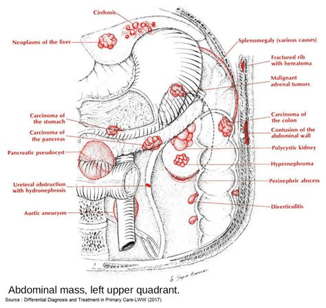 Differential Diagnosis for Abdominal Left Upper Quadrant ... | GrepMed