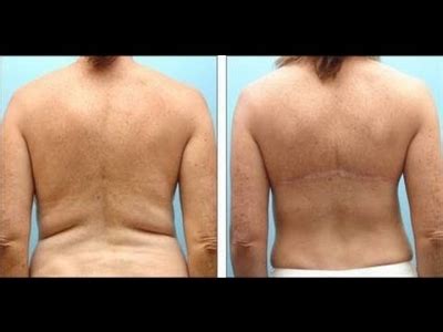 Say goodbye to back fat | Plastic Surgical Center of Rapid City, Prof ...