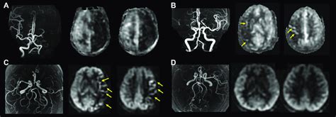 Representative cases with unilateral ICA (A) or MCA (B-D) occlusion ...