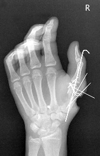 Thumb fractures | Fractured Thumb Treatment