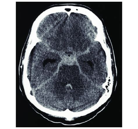 [Figure, STAR Sign Subarachnoid Hemorrhage Flynn...] - StatPearls ...