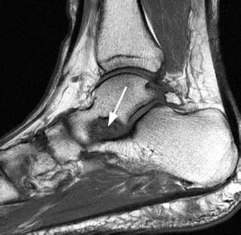 Posterior Tibial Tendinopathy - Radsource