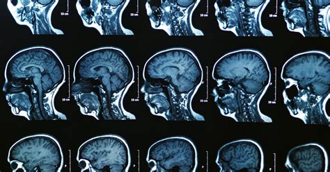 AI identifies three subtypes of multiple sclerosis in MRI brain scans