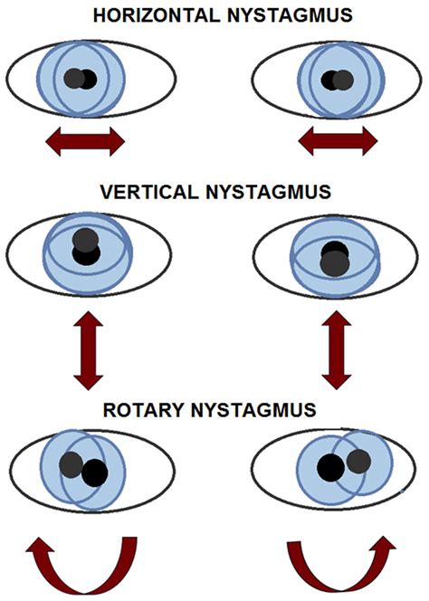 Eye nystagmus causes, types, signs, symptoms, test & nystagmus treatment