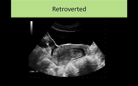 Pin on Pelvic pathology