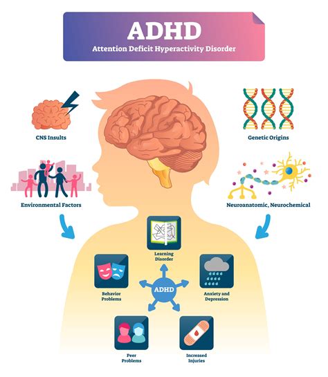 Adhd,Vector,Illustration.,Labeled,Attention,Deficit,Hyperactivity,Disorder,Scheme.,Examples ...