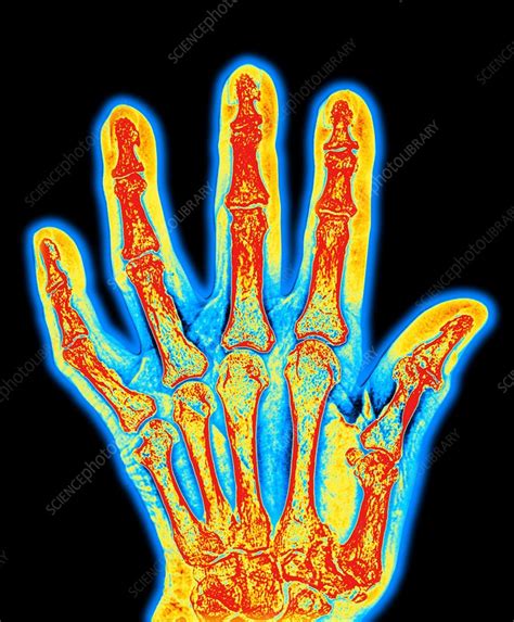 Arthritic hand bones - Stock Image - M110/0527 - Science Photo Library