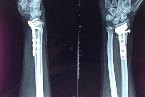 Distal Radius Fracture