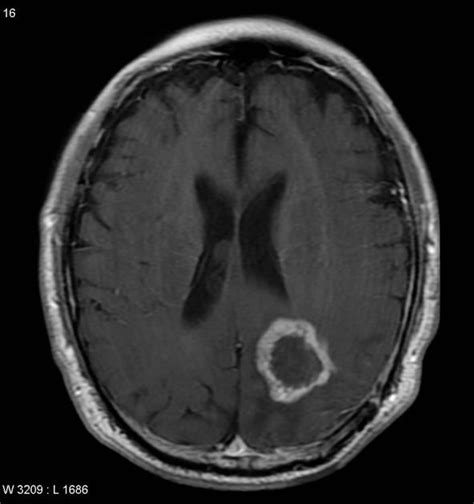 Radionecrosis - ring enhancing | Radiology Case | Radiopaedia.org | Radiology, Mri brain, Mnemonics