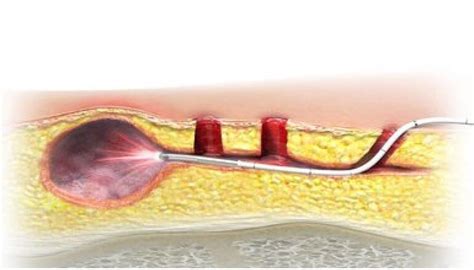 SiLaC® Laser Therapy - Non-Surgical Pilonidal Cyst Treatment