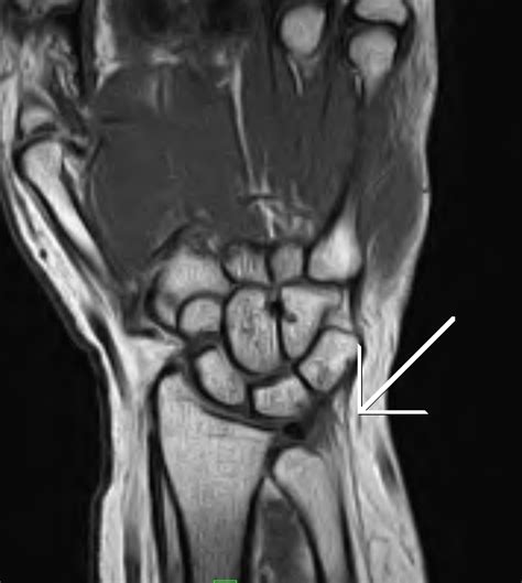 Ulnar Variance - Sumer's Radiology Blog