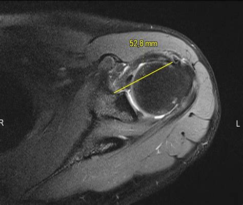 The measurement of the rotator interval base in axial MRI plane | Download Scientific Diagram