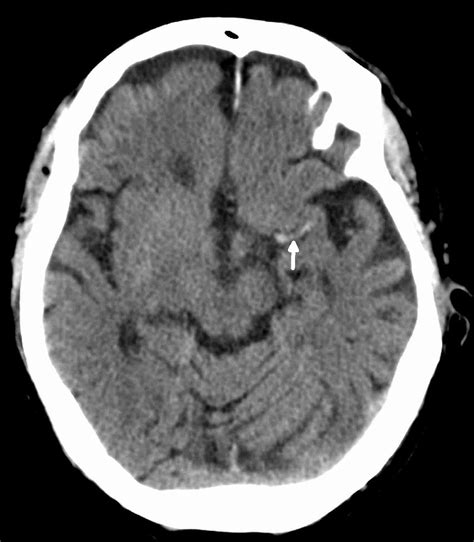 FULL TEXT - Acute middle cerebral artery thrombus - International Journal of Case Reports and ...