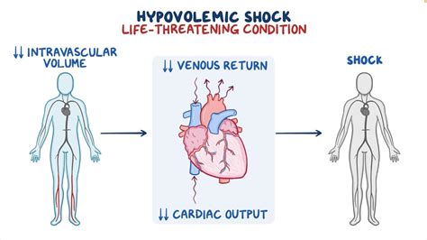 Hypovolemic shock: Clinical sciences - Osmosis Video Library